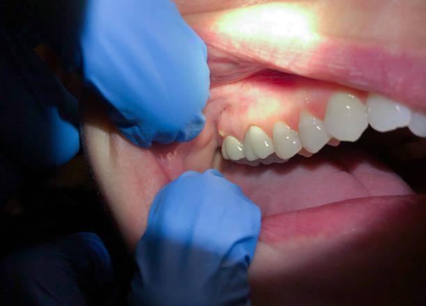 Best Knocked-Out Tooth Emergency  in Bisbee, AZ